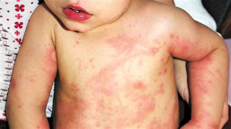 Measles Mumps Rubella What Is The Mmr Vaccine