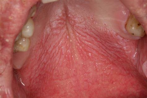 Tiny Bumps On Mouth Roof Gum Problems Types Causes Symptoms Home