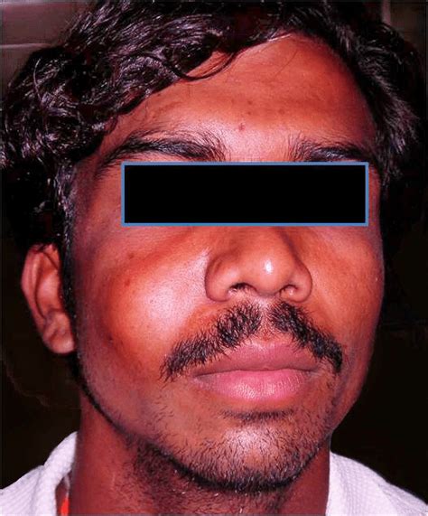 Extraoral Frontal View Showing A Swelling Over The Right Maxillary