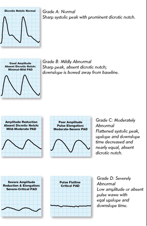 Figure 2 From The Utility Of Pulse Volume Waveforms In The