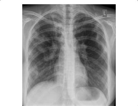 Chest X Ray Showing Patchy Opacification On The Upper Right And