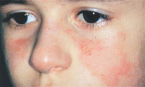 Malar Rash In A Child—quiz Case Dermatology Jama Dermatology The