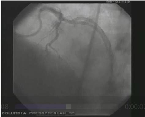 Cardiac Catheterization And Coronary Angiography Patient