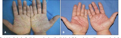 Figure From Hyperkeratotic Hand Eczema Due To Use Of Rubber Gloves While Driving Semantic