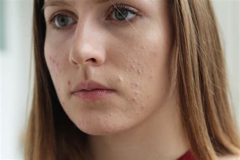 Acne What Is Acne Causes And Types Lloydspharmacy