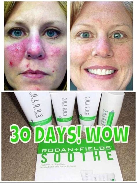 Use Soothe To Heal Your Dry Irritated Skin