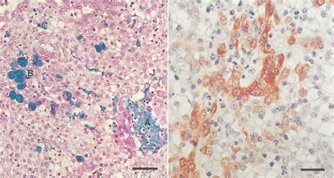 Degree of differentiation based on scoring system of nuclear pleomorphism, mitosis, and necrosis. Lung tumor; dog. Note the Alcian blue-stained ...