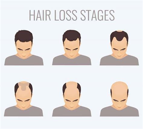 How Long Does It Take To Go Bald — The Definitive Answer For Every Guy