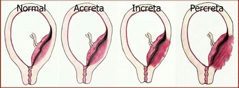 Placenta Accreta Grades Of Abnormal Attachment Illustrated According
