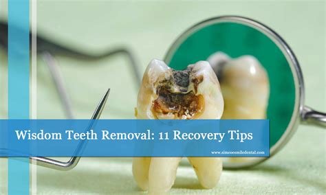 Wisdom Teeth Removal Recovery Tips