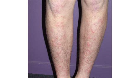 Spotty Skin On Legs Top10retractablehose