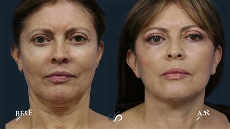 Facial Rejuvenation Neck Lift Co2 Laser Before And After Dr