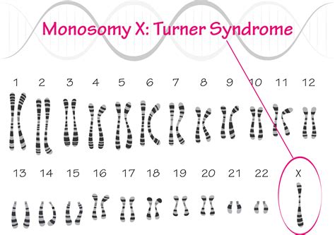 Turner Syndrome Karyotype Monosomy X 7818638 Vector Art At Vecteezy