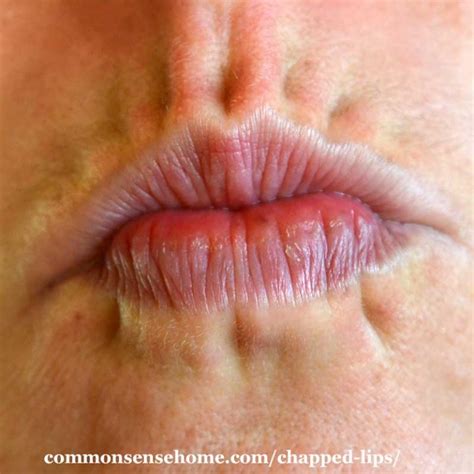 10 Causes Of Chapped Lips Plus How To Get Rid Of Chapped Lips