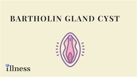 Bartholin S Gland Cyst Overview Causes Symptoms Treatment