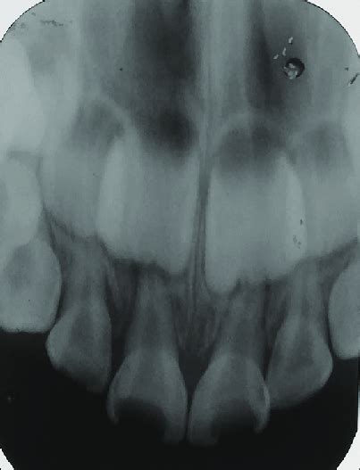 Intraoral Periapical Radiograph Showing Radiolucency Involving Enamel