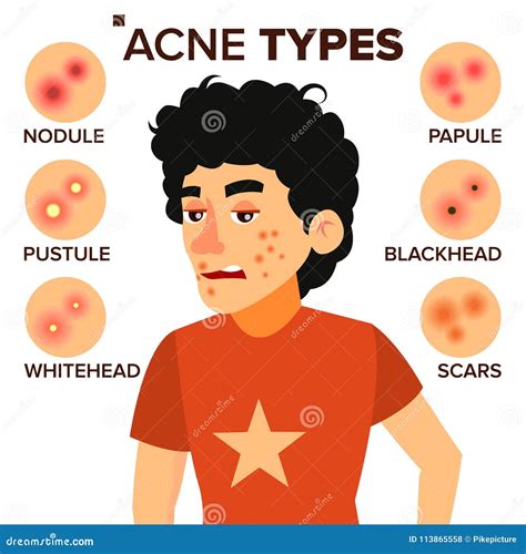 Acne Types Set Skin Disease Dermatology Cosmetology Concept Cartoon
