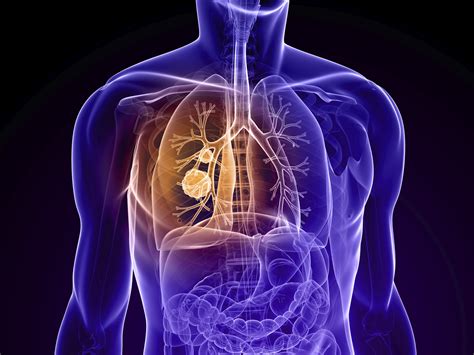 Primary lung tumors, which originate in the lung, are incredibly rare in cats. Defeating Lung Cancer With Early Detection - Health ...
