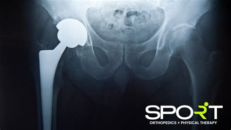 Anterior Hip Replacement Sport Orthopedics Dallas Texas