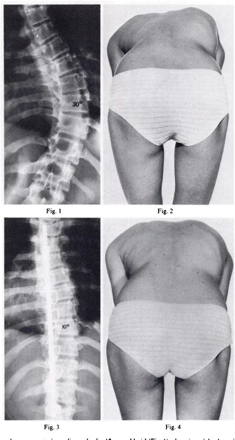 Figure From Surgical Treatment Of Late Onset Idiopathic Thoracic