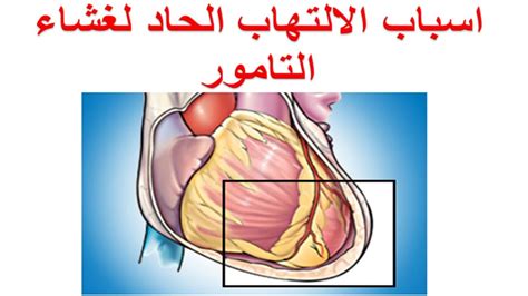 ما هي اسباب الالتهاب الحاد لغشاء التامور ؟ اسباب التهاب الغشاء المحيط بعضلة القلب Youtube