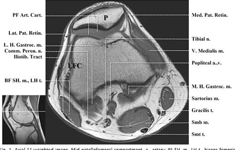 These are essential structures to evaluate in routine assessment of the knee on mri. Figure 1 from Normal MR imaging anatomy of the knee. | Semantic Scholar