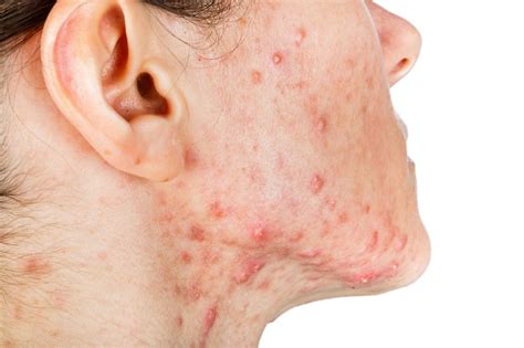 Cystic Acne Your Guide To Causes And Management