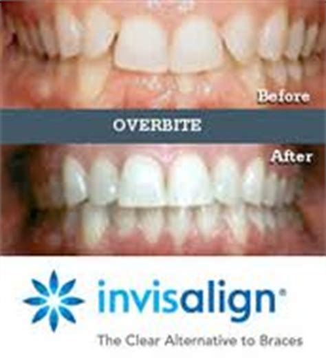 If you don't want orthodontic treatment, you may get crown or veneer to fix the overbite. Orthodontics Archives - Page 2 of 3 - Dr George DDS