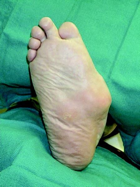 Managing Ulcers On The Charcot Foot