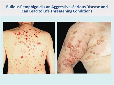 Bullous Pemphigoid Is An Aggressive Serious Disease And Can Lead To