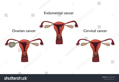 Ovarian Endometrial Cervical Cancer Human Realistic Stock Vector Royalty Free