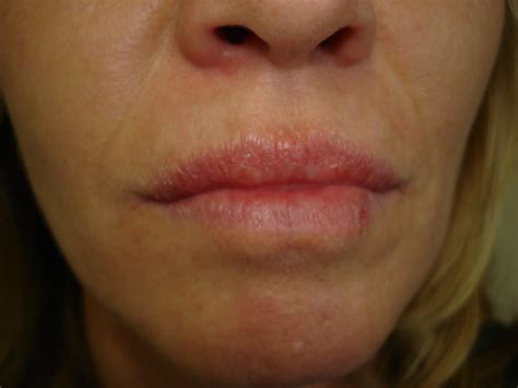 Lip Eczema Pictures Photos