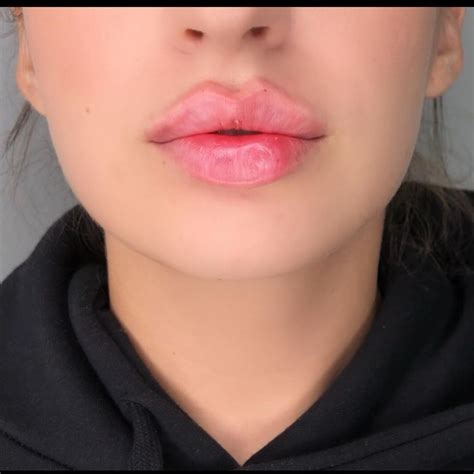 Pin By Lalily On No Lip Fillers Botox Lips Natural Lips