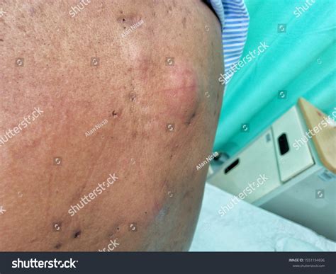 Multiple Infected Sebaceous Cyst Back Patient Stock Photo 1551194696