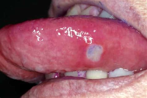 White spots on tongue in children, particularly newborn babies are mostly caused by deposits of milk particles leading to his type of such infection. White Spots on Tongue, Tip, Side, Under, Back, Dots ...