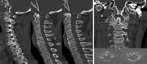 Hyperextension Injury Of The C1c2 Cervical Spine With Neurologic