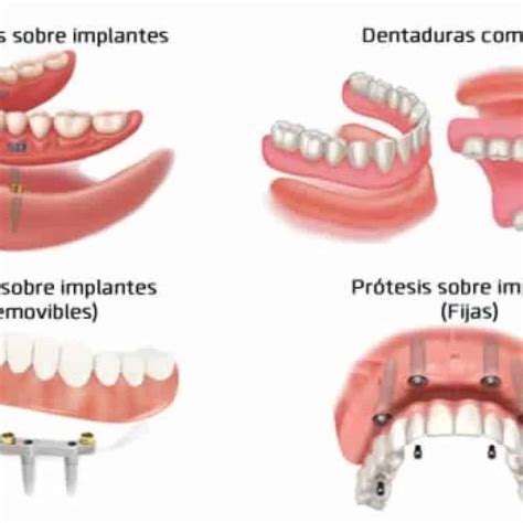 Dentadura Postiza Precio Tipos Cuidado De Prótesis Removible
