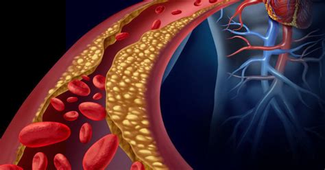 Atherosclerosis And Heart Disease • Heart Research Institute Nz