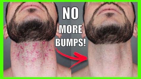 Ingrown armpit hair is common and harmless. How to Get Rid of RAZOR BUMPS & INGROWN HAIR FAST | Face ...