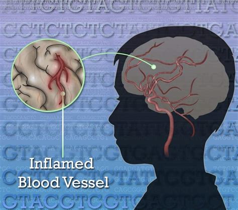 Nih Team Discovers Genetic Disorder Causing Strokes And Vascular