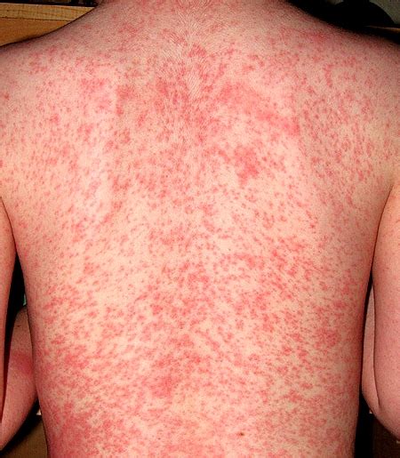 Heat Rash Pictures Treatment Causes Types Symptoms Prevention