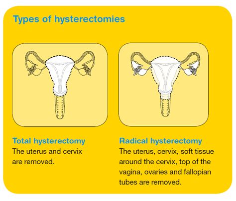 Radical Hysterectomy Types