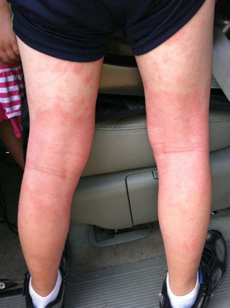 Eczema And Allergies In 6 Year Old Patient Helped By Chiropractor In
