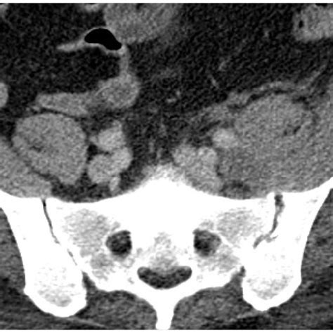 Axial Mri T2 Weighted Image Showing The Large Iliopsoas Abscess