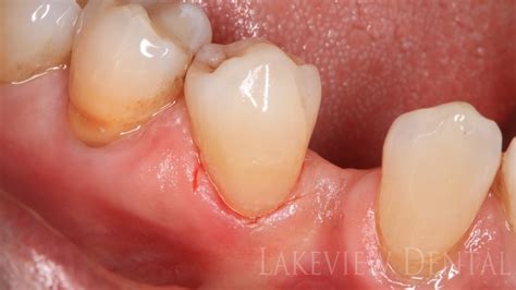 Abfraction And Eroison Lakeview Dental