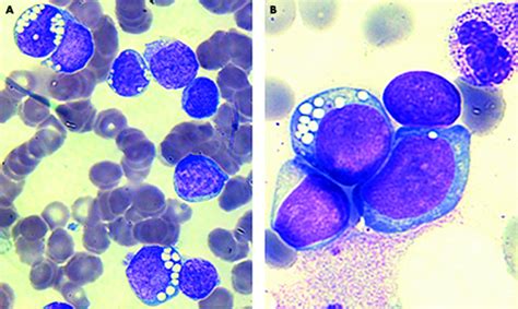 Acute Lymphoblastic Leukaemia Of The L3 Subtype In Adults In The