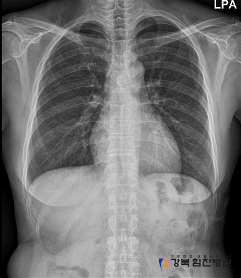 The cause of dextrocardia is unknown. x-ray/흉부 Chest PA 대해 알아 보아요. : 네이버 블로그