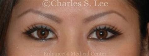 Update On Asian Double Eyelid Plastic Surgery Nuances Charles S