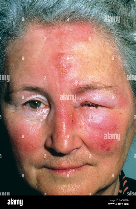 Herpes Zoster View Of The Face Of An Elderly Woman With Shingles Also