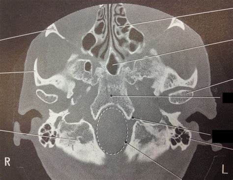 227 Axial Occipital Bone Flickr Photo Sharing